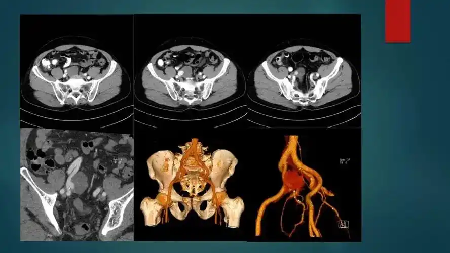 【x121】假性动脉瘤
