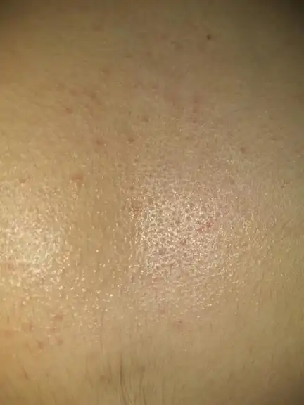 我有更好的答案 3条回答 前胸后背都有豆豆吗 追问 是的  追5555风