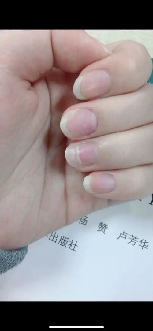 痛苦的4年甲营养不良患者本人