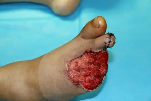 经清创vsd材料保护创面治疗后二期创面情况