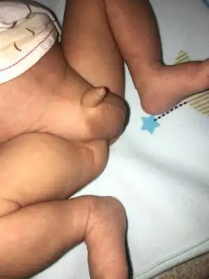 请问各位宝妈,刚出生26天的宝宝,鸡鸡和蛋蛋突然变