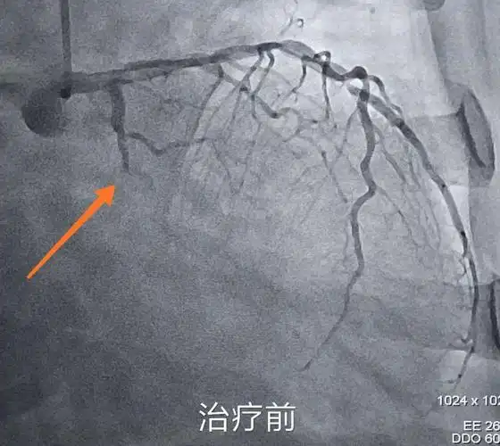 急诊冠脉造影示:回旋支近段闭塞.