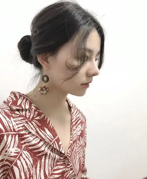 膨体隆鼻好不好_效果图_氧气zz1m0膨体隆鼻术后第94天_新氧美容整形