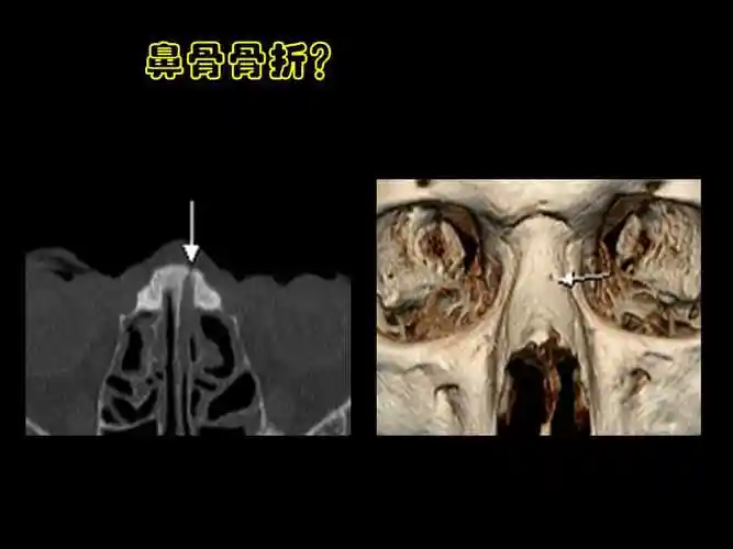 鼻骨与副鼻窦解剖ppt课件ppt