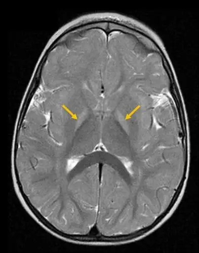 胆红素脑病,t2及flar高兴号