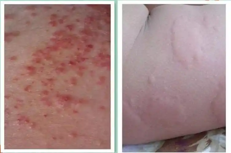 如何区分荨麻疹和湿疹
