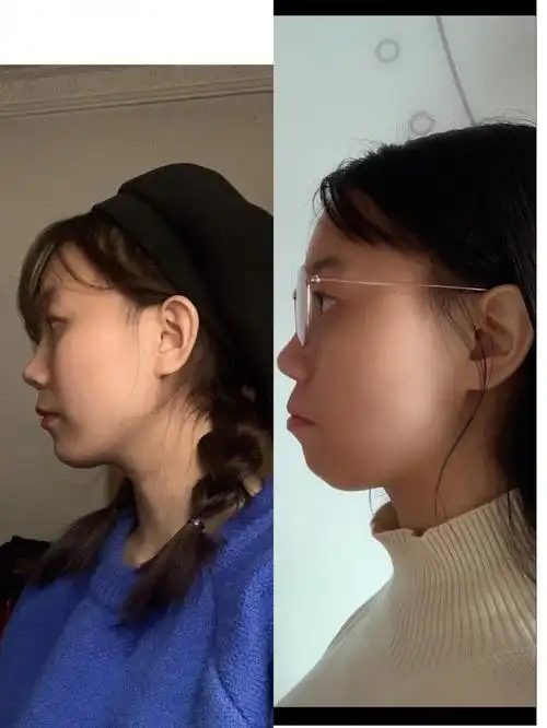 戴牙套前后对比