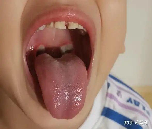 小孩4岁,腺样体肿大,做鼻内镜低温等离子消融手术,容易复发吗? - 知乎