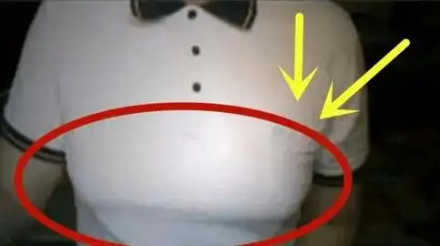 浙江丨20岁小伙羞答答就医健身两年后胸部比女朋友的还大