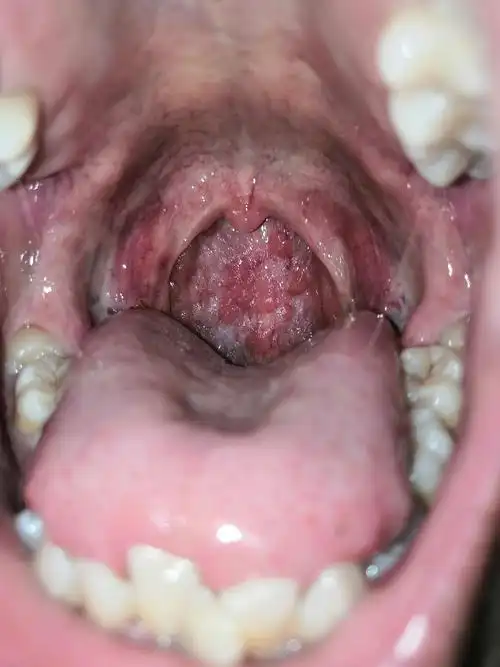 喉咙里为啥是这样?