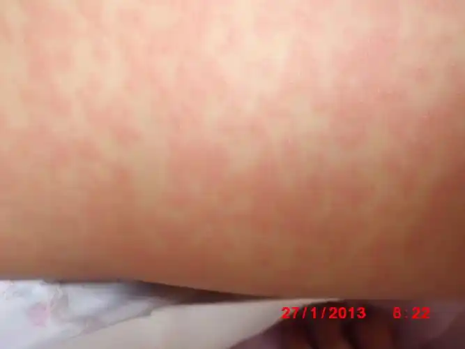 宝宝九个半月出疹子