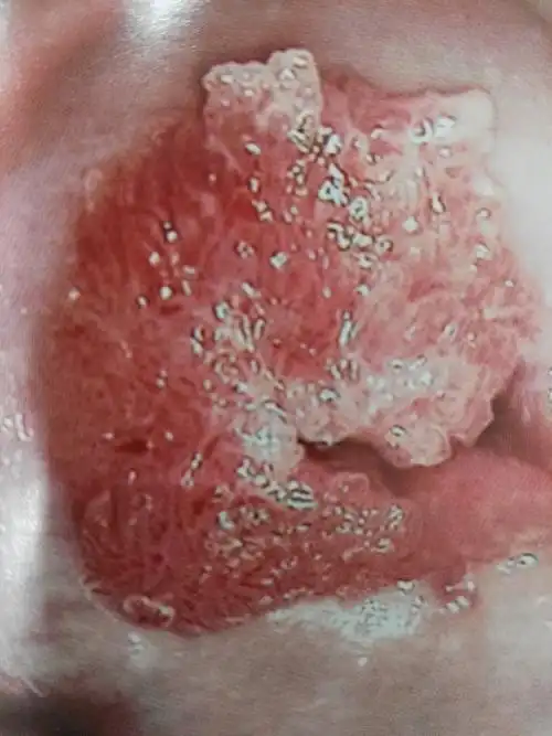 宫颈口看似糜烂,其实是宫颈尖锐湿疣,没有涂醋酸,呈红色如果怀疑自己