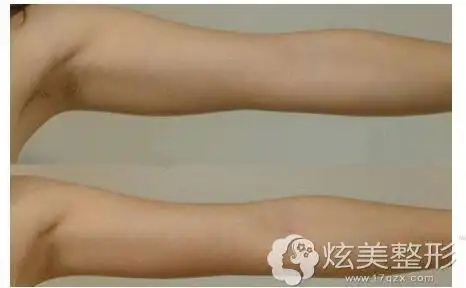 水动力吸脂瘦手臂前后对比