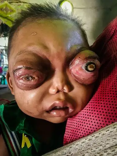 印度2岁童出生后「双眼莫名肿大」快掉出来,没钱治