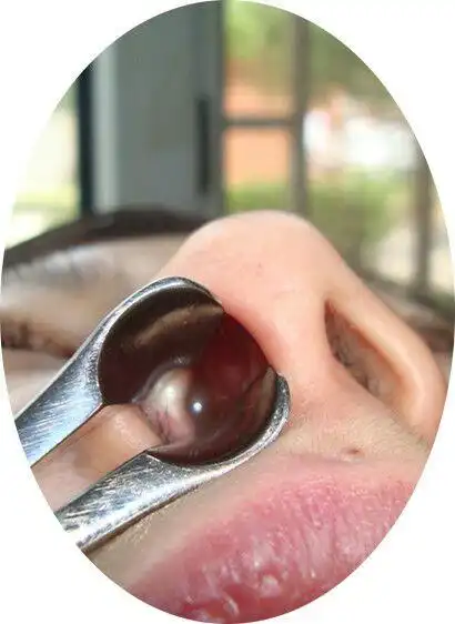 其它 鼻息肉对我们的危害性 写美篇康贝专业小儿推拿鼻炎特色疗法欢迎