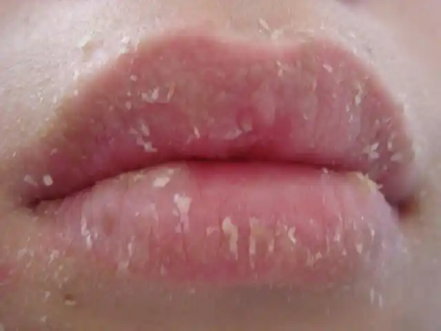 慢性唇炎怎么预防? - 忠嘉齿兮 - 牙医博客忠嘉齿兮