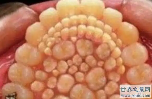 世界上牙齿最多的人,竟然长出了37颗牙!