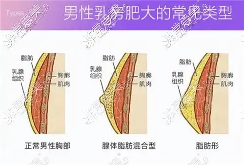 男人胸部肥大的常见类型示意图