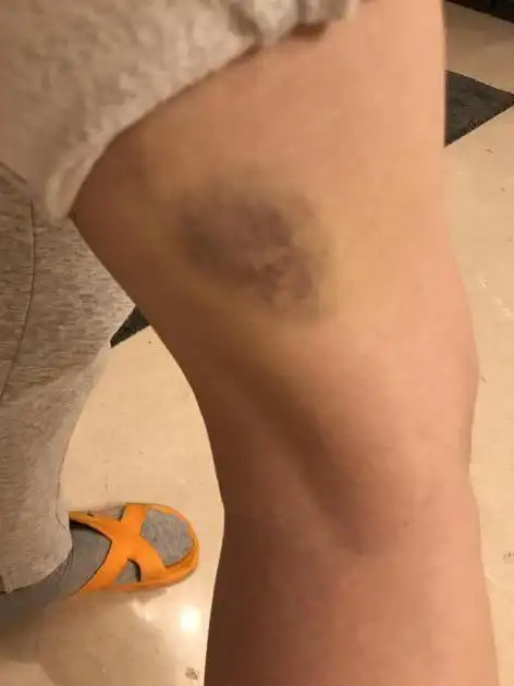 周美毅身体多处淤青