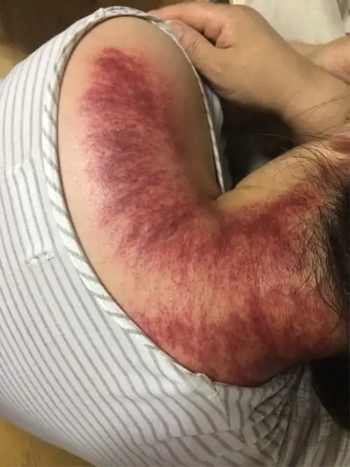 我就问她是前头痛,还是后头痛,她说是前头痛,我就说刮痧能治疗头痛