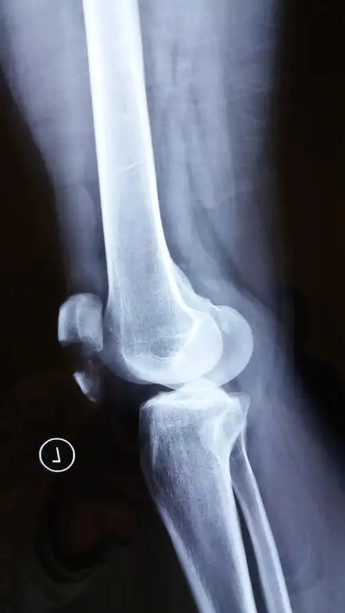 髌骨横型骨折,术前术后影像对比 - 好大夫在线