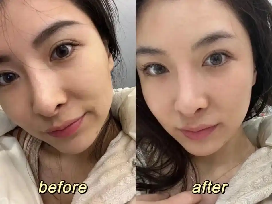 光子嫩肤治疗后反黑,是不是代表治疗无效了?反黑如何应对?