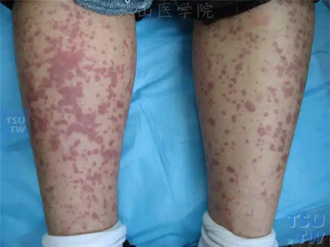 双小腿伸侧对称分布大小不等紫红色瘀点,瘀斑,压之不退色