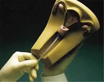 女人上环有什么危害对于上环你了解多少