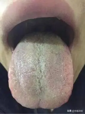 很多人伸出舌头一看,舌头两侧牙印很重,这种情况中医叫做齿痕舌,同时