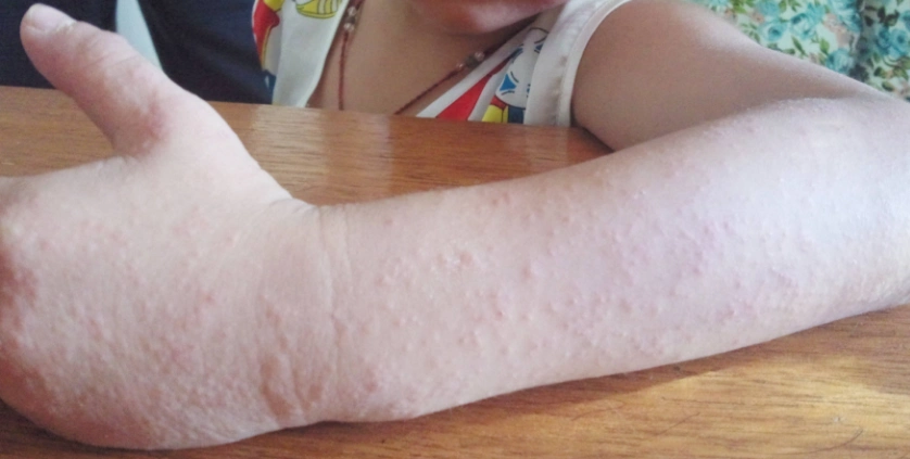 三沙市皮炎专家_三沙市治疗皮炎哪个专家好_三沙市治疗皮炎最好的专家