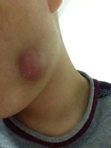 本人25岁,今年5月份开始智齿发炎,刚刚开始一个月大概一次到两次的