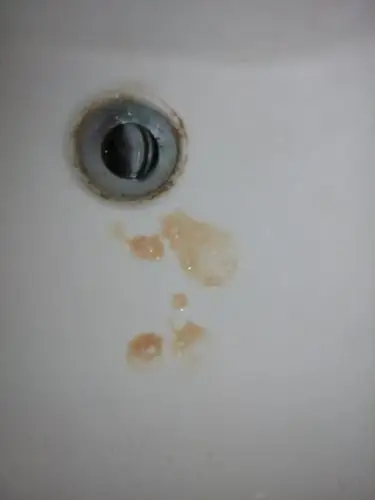 吐出来的痰怎么会这样啊?看相片