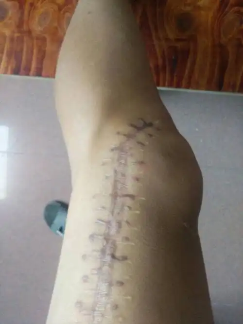 本人骑车受伤大腿粉碎性骨折,现已3年了,如今腿已经康复钢板也取出,但