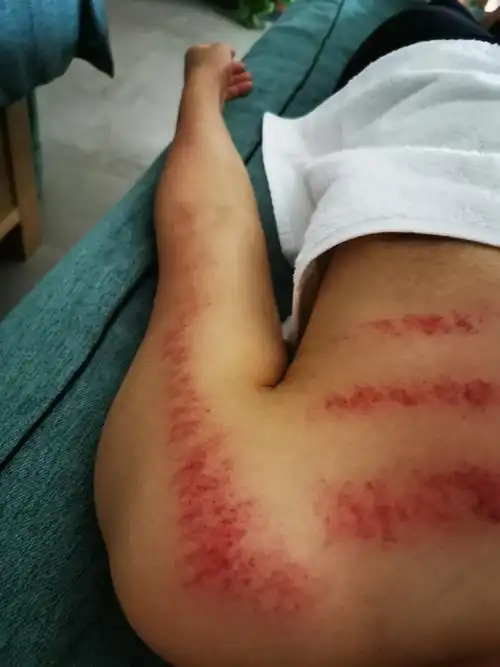 刮痧图