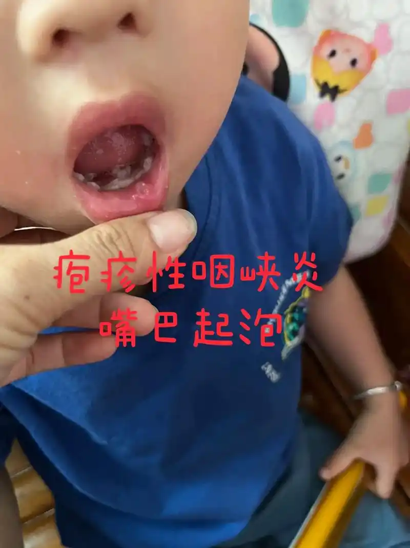疱疹性咽峡炎太痛苦了,吃东西都嘴巴痛.这个病太费孩子了,饿了 - 抖音