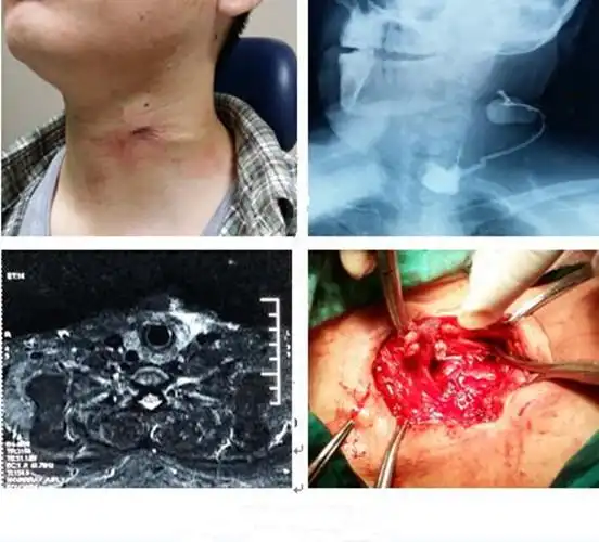 喉肿瘤的详细的图片