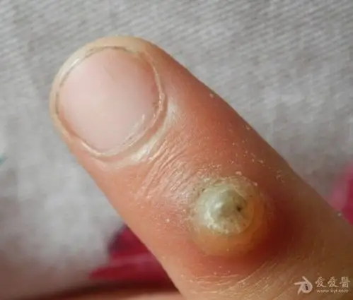 记录我寻常疣的全过程