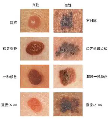 色素痣还是黑素瘤