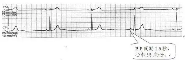 检查心脏,心电图,心脏彩超哪个更准确?看看医生怎么说