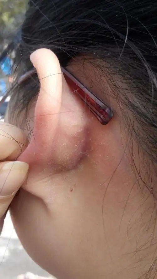 我的两只耳朵背后都有不同程度的蜕皮,现在在耳朵里也有蜕皮,想问这是