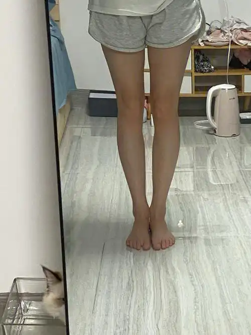 叔贵小腿外翻矫正打卡day4