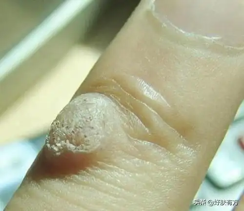 寻常疣,由人类乳头状瘤病毒(hpv)引起的表皮良性赘生物水猴子怎么治疗