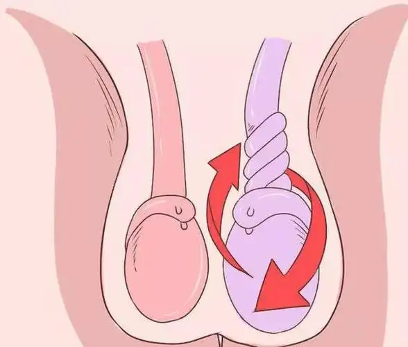 正常的睾丸与睾丸扭转对比一般剧烈运动,阴囊外伤(碰撞,被踢),天气