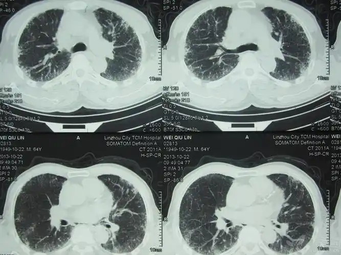 【病例会诊】肺部ct 请各位专家帮忙看看 患者咳嗽4个月痰少 难于诊断