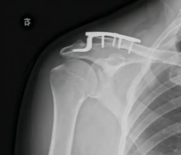 男子车祸致肩锁关节脱位微创手术复位快速康复