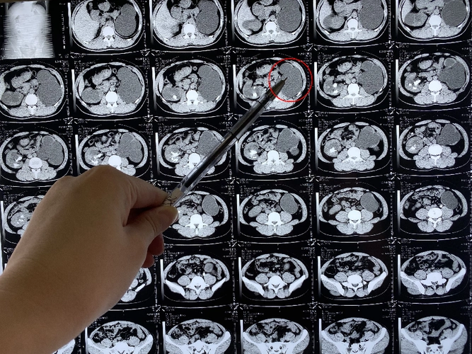 被冷处理的沉默结石竟令男子左肾几乎报废