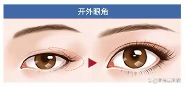 开眼角和不开的区别图!哪些人适合开眼角?