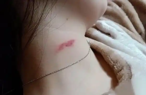 掐的草莓儿和亲的草莓印,在形状上是不同的.亲的草莓印属于吻痕.