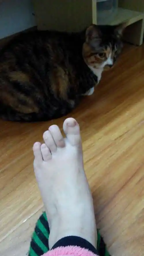 关于第四脚趾短小症的困惑