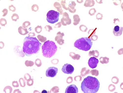 其它 2018年细胞形态学培训考试 a:豪焦小体 b: rusell小体 c:杜勒小